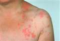 DOCTOR CALLING: Protect yourself against shingles