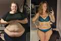 ‘I am basically finding out who I am all over again after gastric sleeve operation in Turkey’
