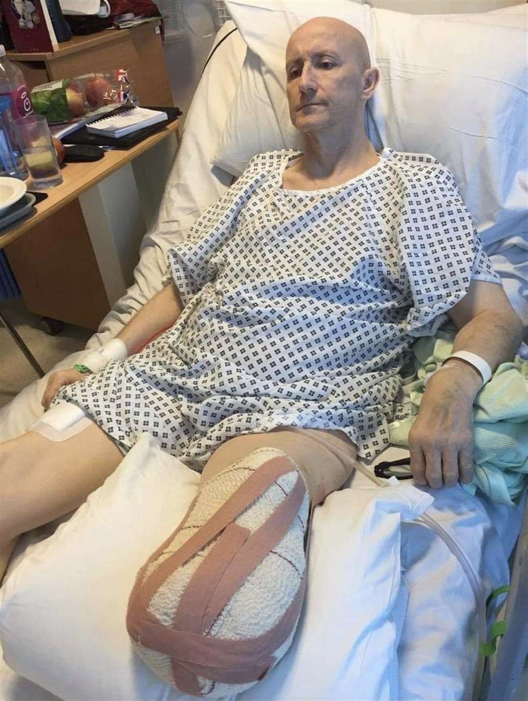 Dave Mears had his leg amputated below the knee following a severe infection which he fears could be linked to the covid vaccine
