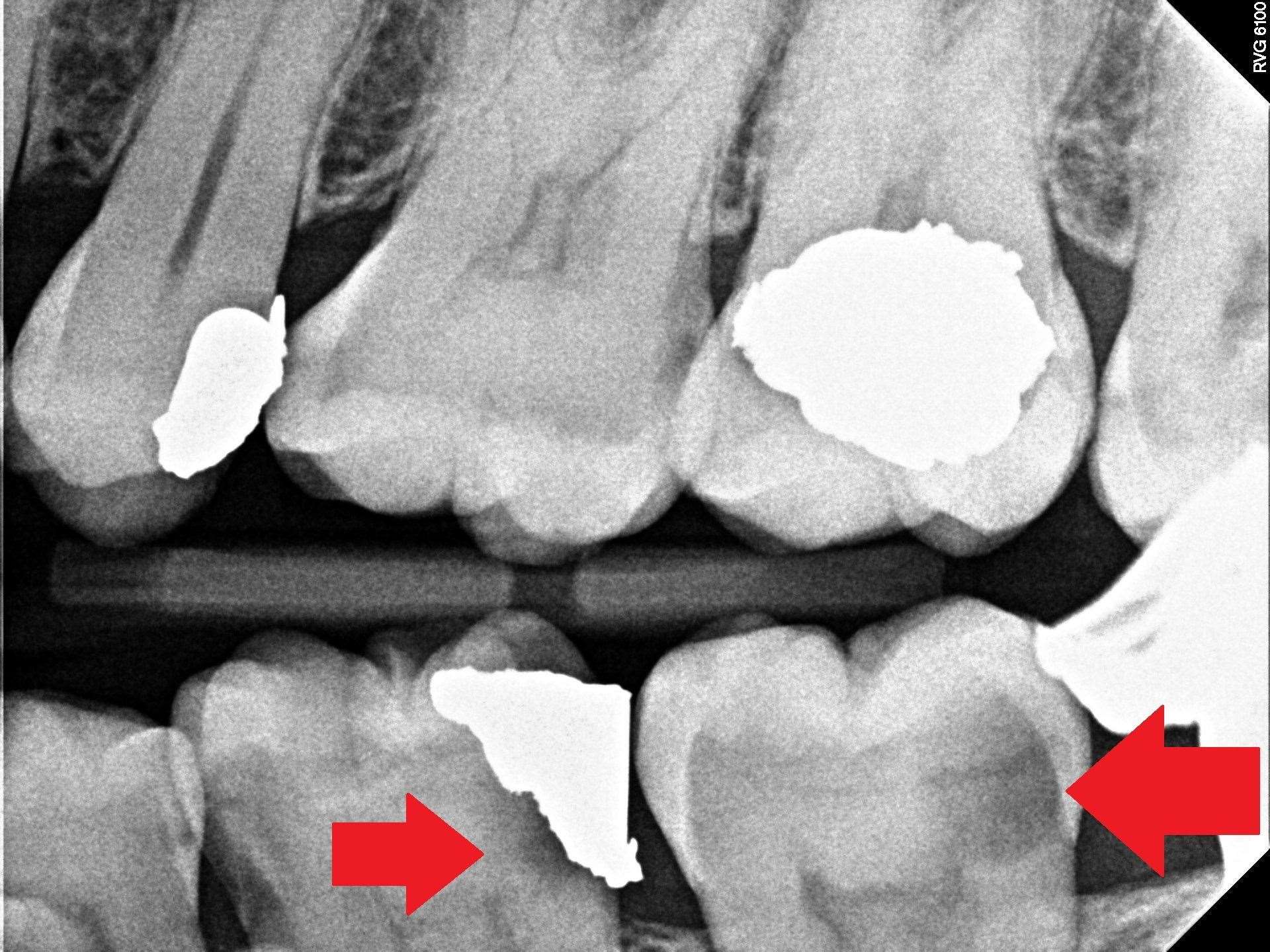 The large areas of untreated dental decay in James' mouth