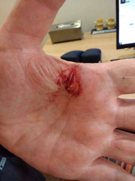 The injury which was sustained.