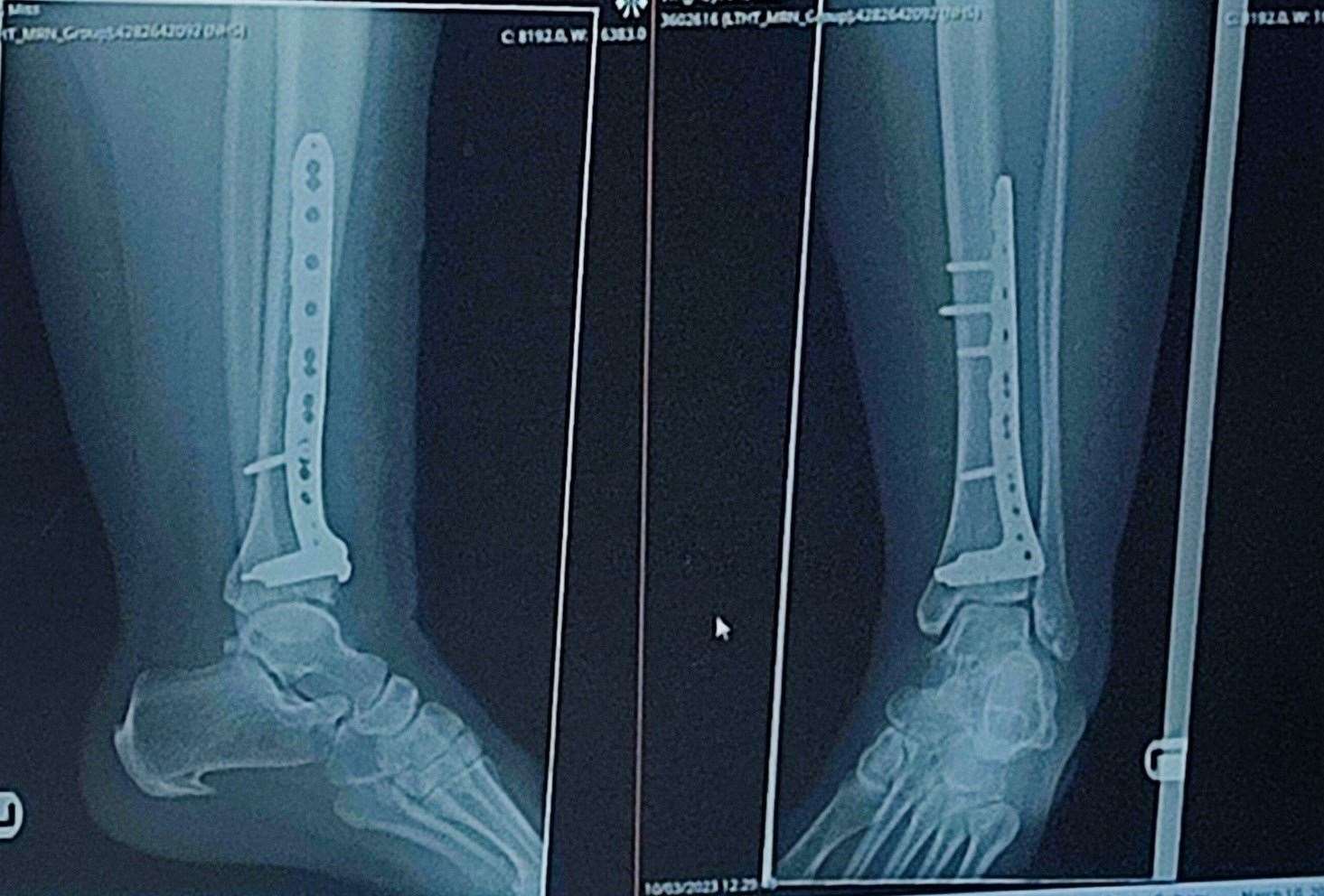 X-ray images show the state inside Jodie's leg