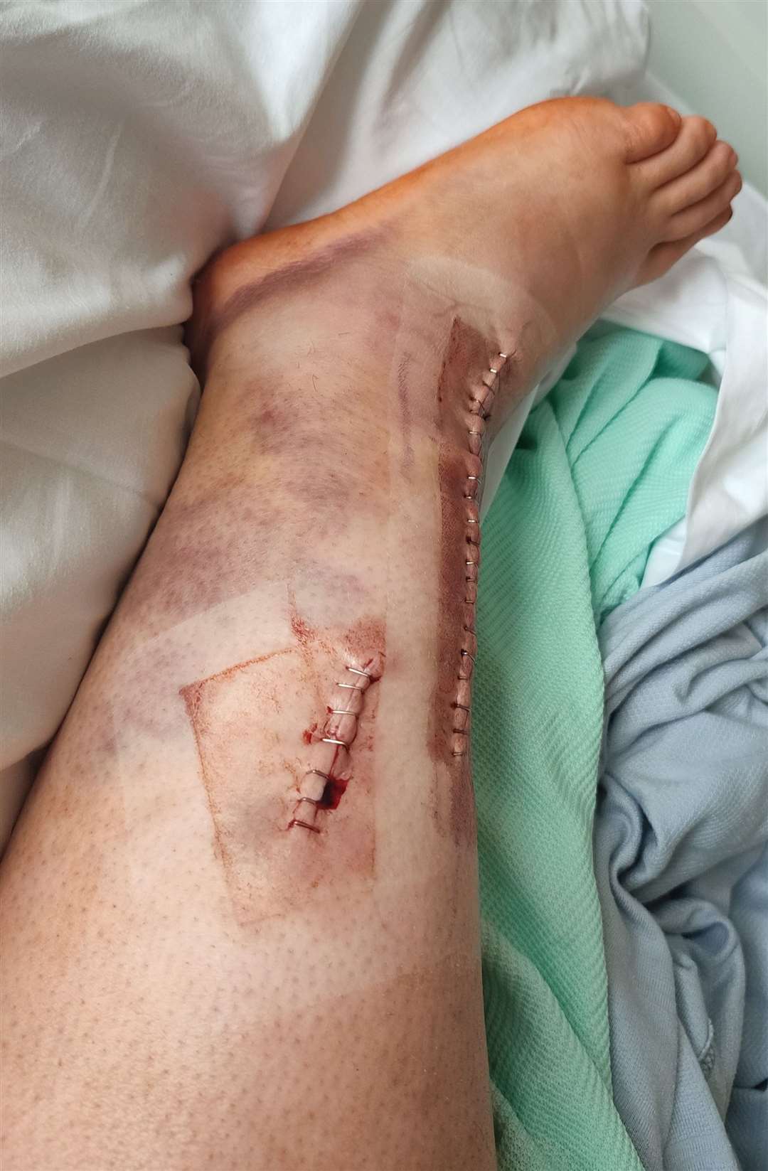 Jodie's leg after the incident