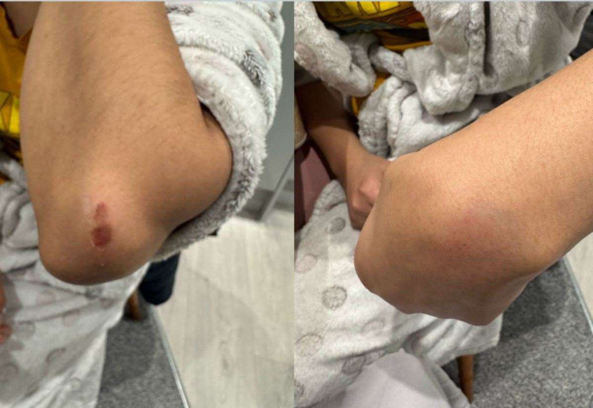 The nurse suffered injuries to her elbow, wrist and ankle. Photo: Supplied