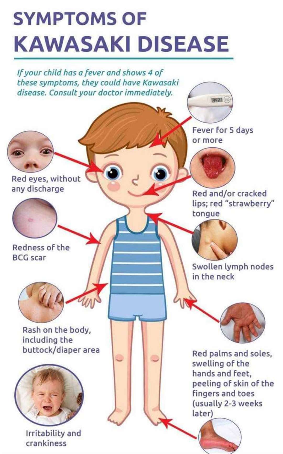 The symptoms of Kawasaki Disease