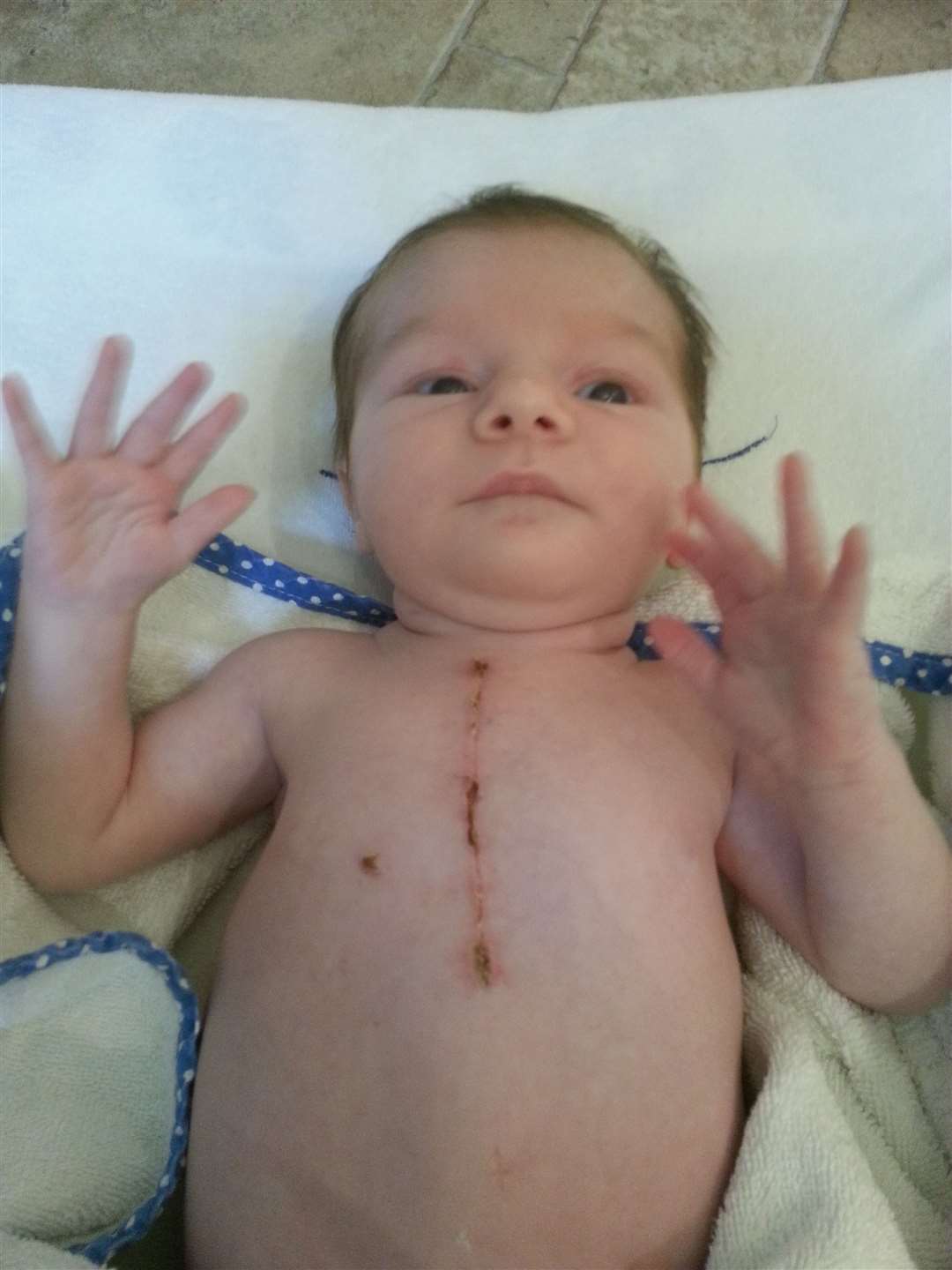 Tilly Foster as a baby after heart surgery. (40332899)