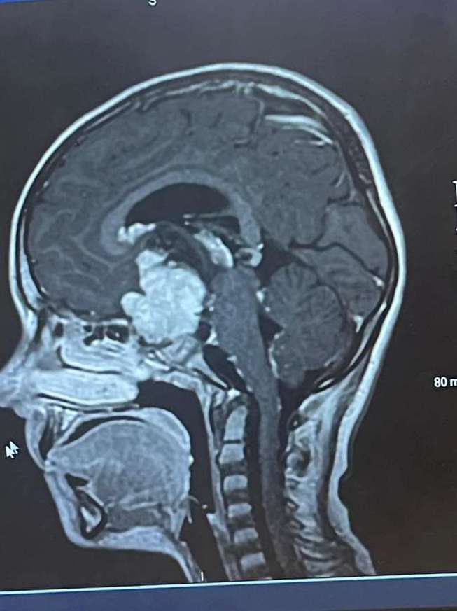 Jack is bravely battling brain cancer
