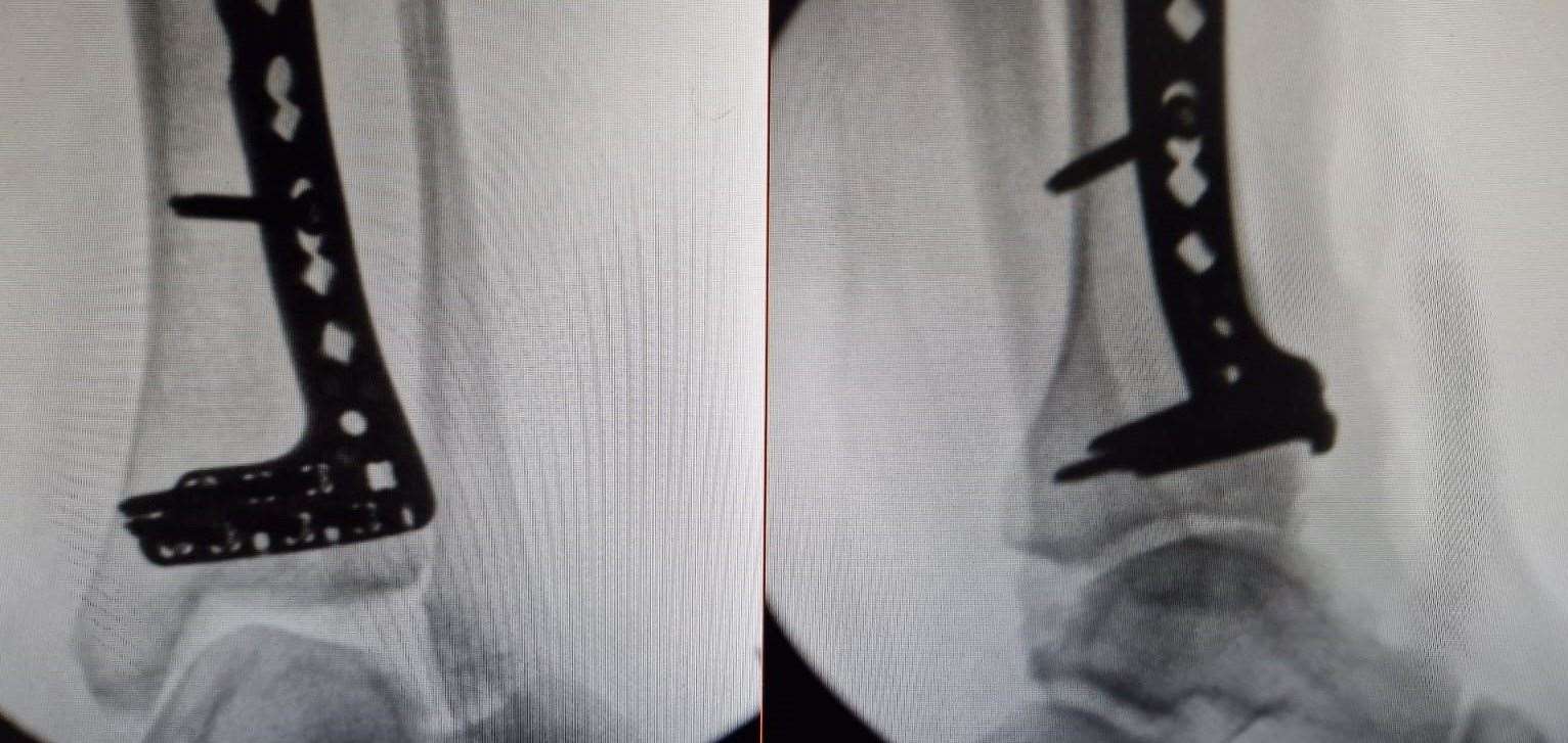 The metalwork in Jodie's leg