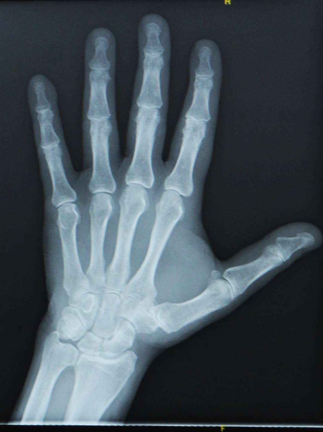 X-rays fortunately found no breaks.